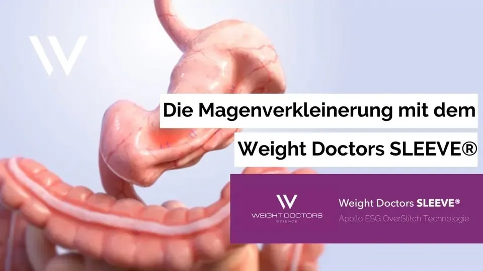 The Weight Doctors SLEEVE® procedure in an animated video
